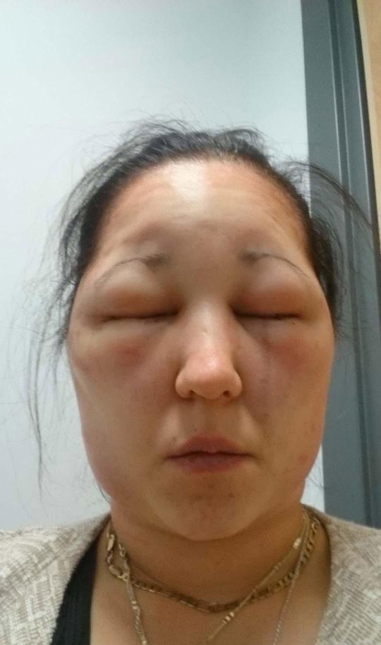 女子立刻打车去了医院,医生说,这是明显的过敏症状,需要立刻进行治疗.