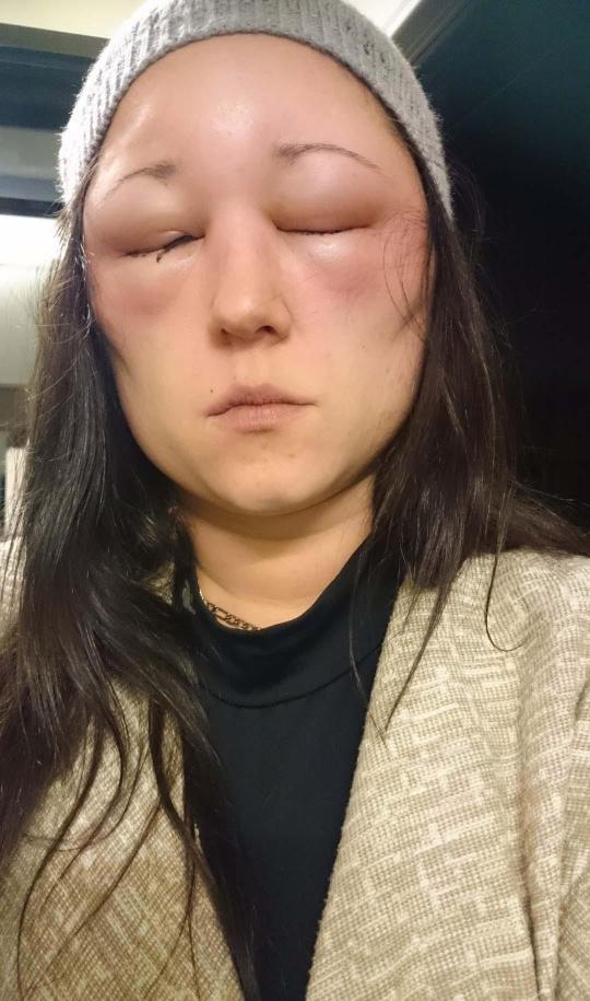 女子在理发店染发后脸肿成球, 她的身份让人争论