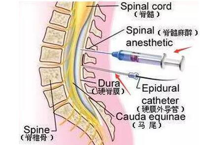 怀孕分娩时打的麻醉会伤腰,影响记忆力吗, 准妈妈们都要知道