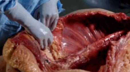 英国人切开了230斤的胖子检查了他的身体