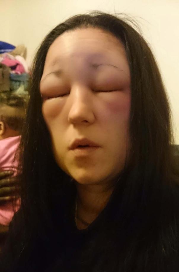 女子在理发店染发后脸肿成球, 她的身份让人争论