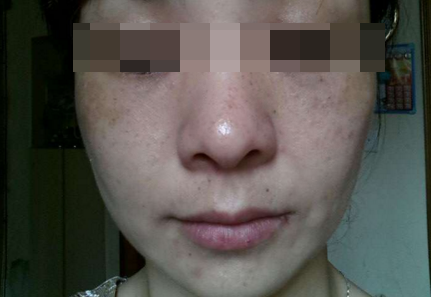 黄褐斑总祛不掉?3大感光食物少吃,4种让皮肤白嫩食物要多吃