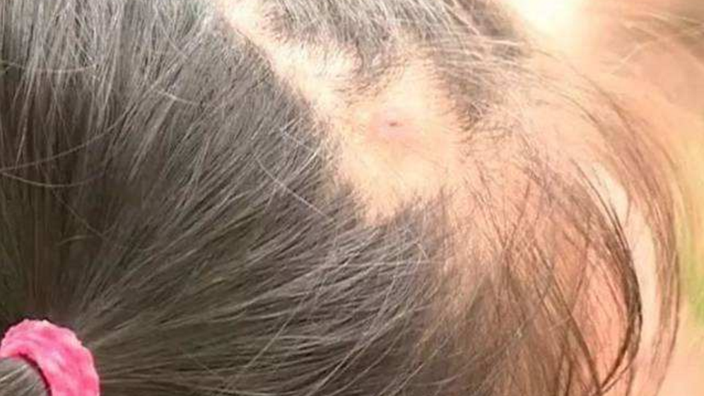 爸爸给女儿梳头,发现头皮突现"白米粒",医生:幸亏来得及时!