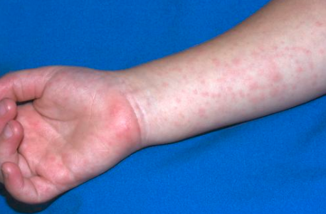 儿童神经性皮炎会自愈吗事实证明你想多了