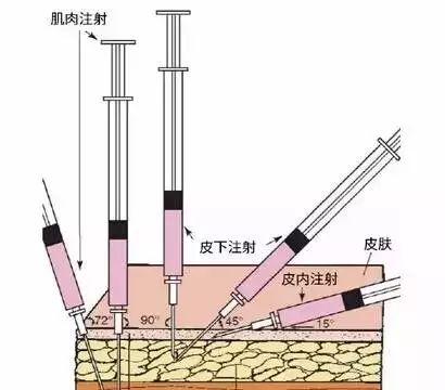 皮内注射、皮下注射、肌肉注射、静脉注射的区别!_新浪新闻