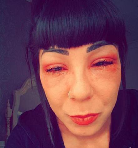 25岁女子整容失败导致眼睛无法睁开差点变成瞎子