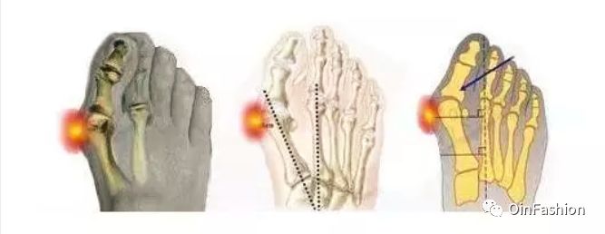 刘诗诗体态好气质佳,但她为什么对小脚丫遮遮