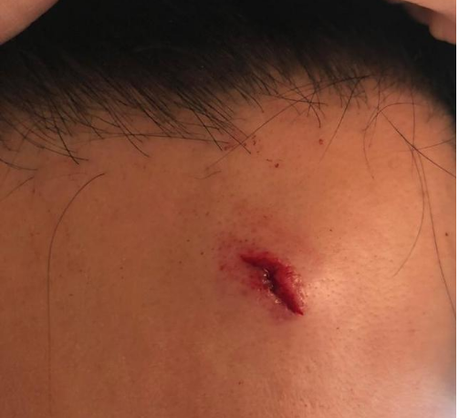 李晨头部缝九针,网友:范冰冰这反应很准媳妇