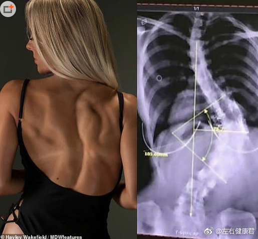 女孩拒绝手术治疗脊椎侧弯通过健身矫正变网红