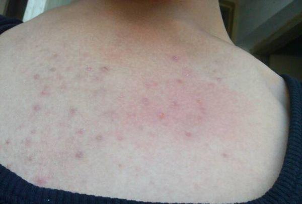 后背上是毛囊炎还是鸡皮肤(怎么判断是毛囊炎还是鸡皮肤)