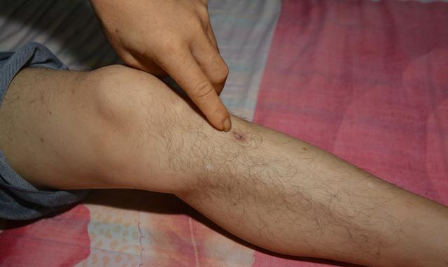 尿毒症早期7个症状,都没有的幸运,2个以上小心,4个以上警惕