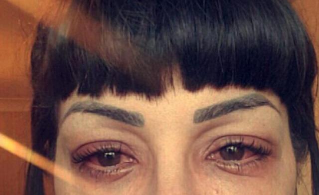 25岁女子整容失败导致眼睛无法睁开差点变成瞎子