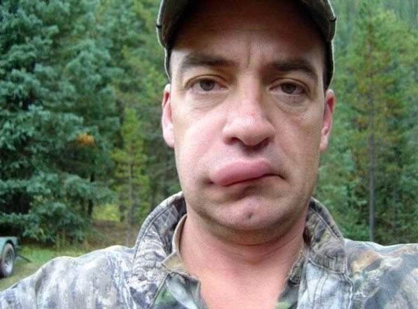 被蜜蜂"亲吻"之后的香肠嘴,看看他们就能笑喷了|蜜蜂|马蜂|蜂种_新浪