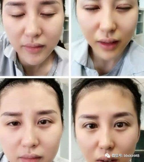 次双眼皮修复成功的真实案例,效果前后对比图片