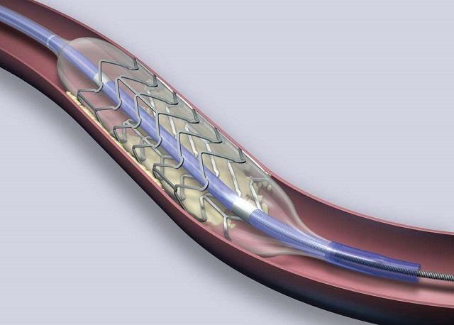 心血管医生告诉您:放完支架要记住的十件事