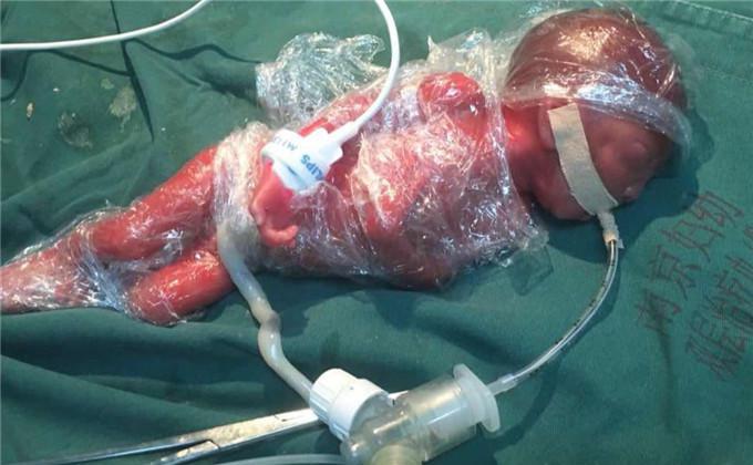 孕妇怀孕22周早产 宝宝只有巴掌大小仅1.1斤重