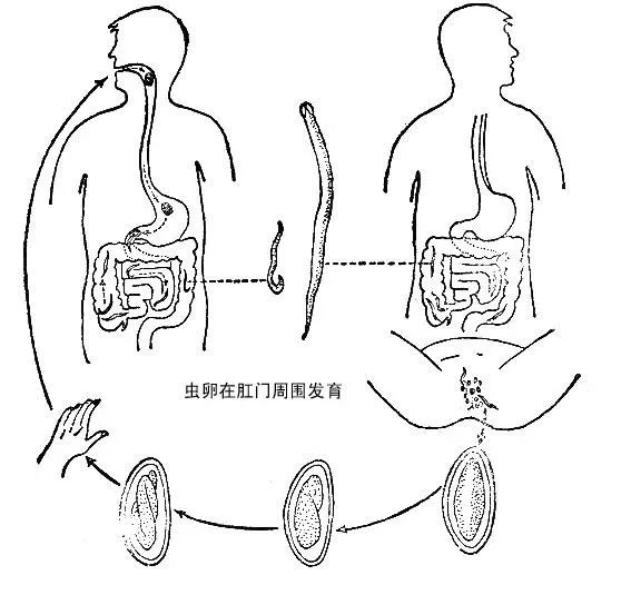 肛门瘙痒睡眠差消化异常警惕这种寄生虫病
