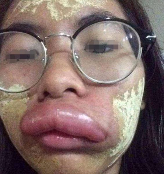 女子一觉醒来,嘴唇竟变成了巨型"香肠",医生看后都忍不住笑了