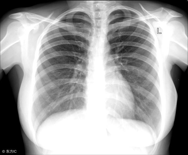 肺癌典型症状是不明原因的胸痛,发热,痰中带血,咳嗽等,一旦出现这些