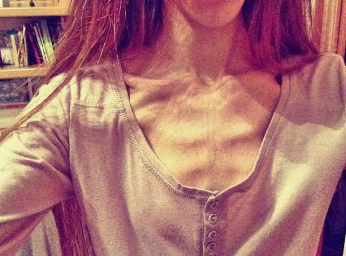 意大利女孩吃零食成瘾被甩,一气戒掉零食,没想到又患上厌食症!