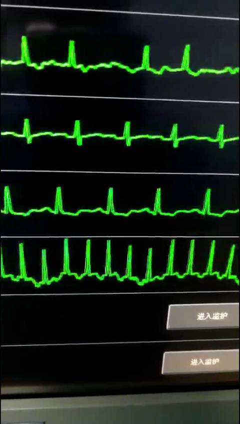 那天,路过护士台,看到心电监护仪显示器上,有个病人的心电图不对