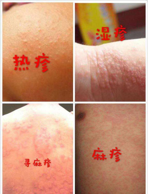 宝宝来急疹发烧怎么办收好这份育儿知识之幼儿急疹篇