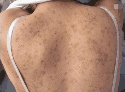 为什么皮肤上变成螨虫窝,2种方法可以看出,3招教你除螨