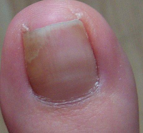 没想到灰指甲竟然是这样传染的早知道早预防