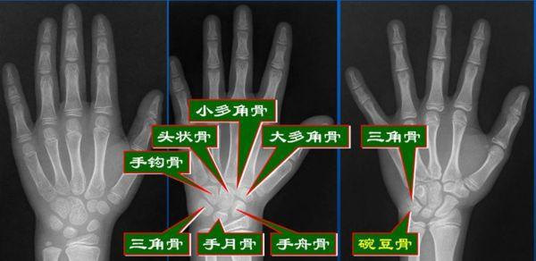 骨龄测试,骨骺闭合,孩子终身停止生长