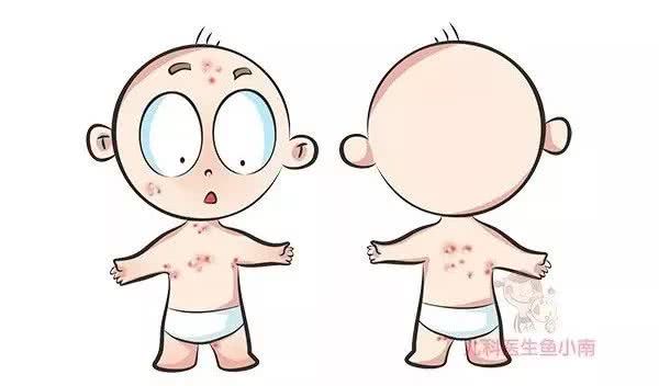 4,药物疹顾名思义,因为使用药物引起.