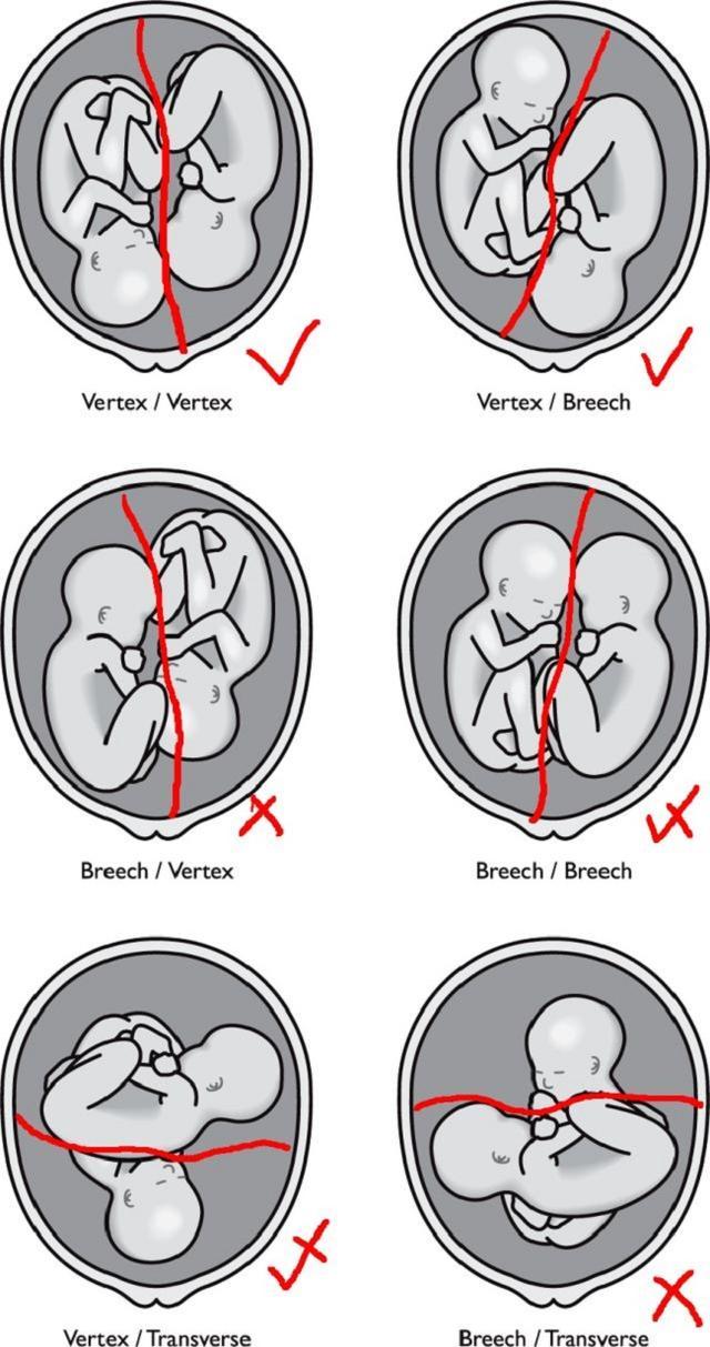 假如选择顺产是不是风险很大?