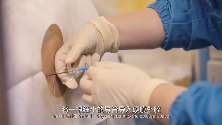 无痛针到底怎么打组图揭秘全过程每看一次都会觉得腰酸一次