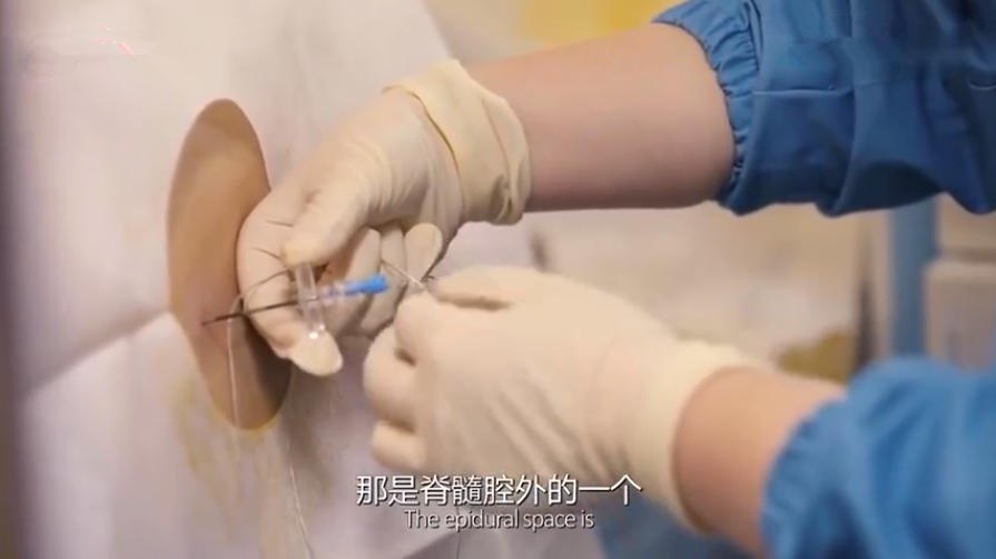 无痛针到底怎么打组图揭秘全过程每看一次都会觉得腰酸一次