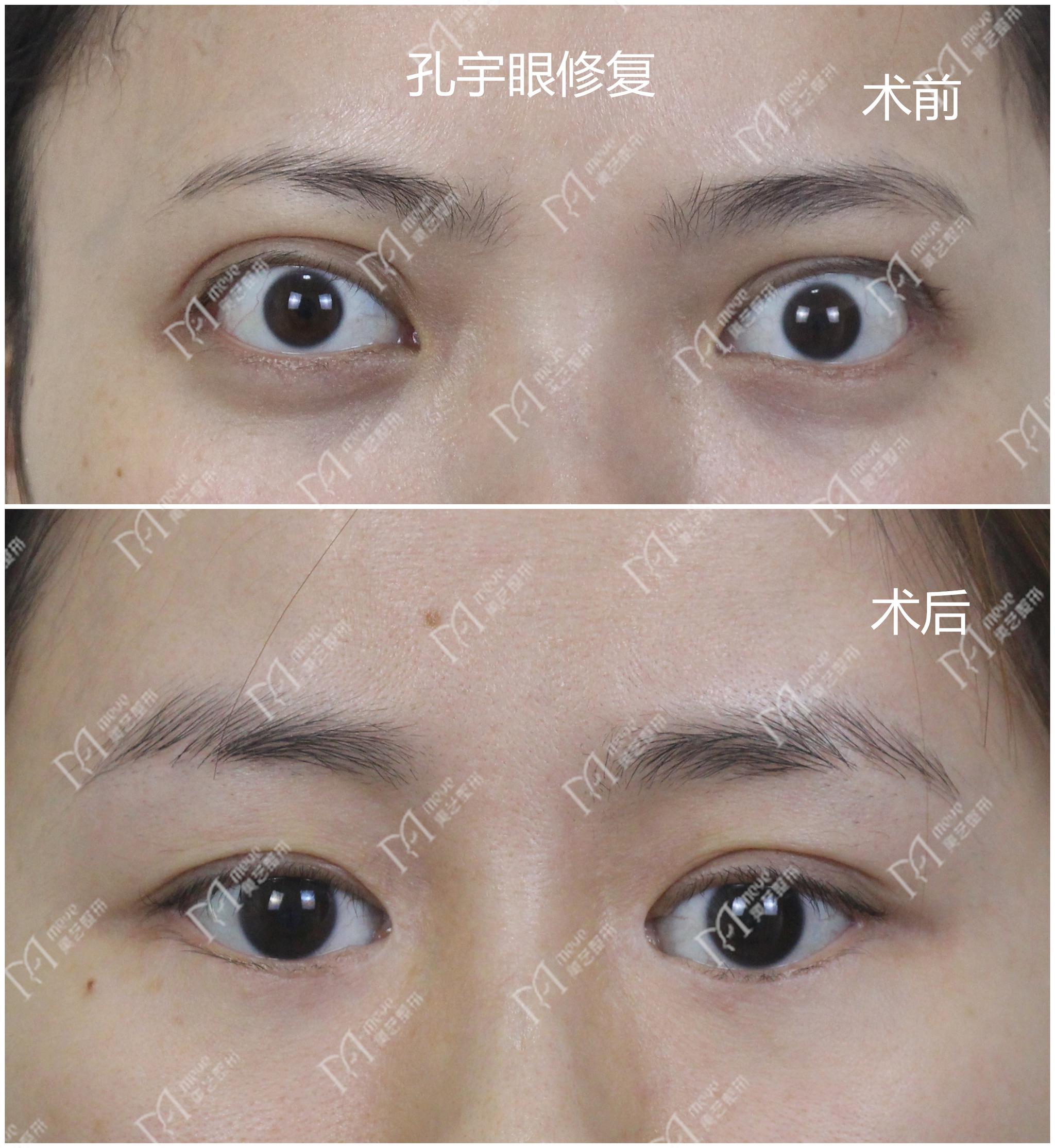 上眼睑退缩也不要忽视