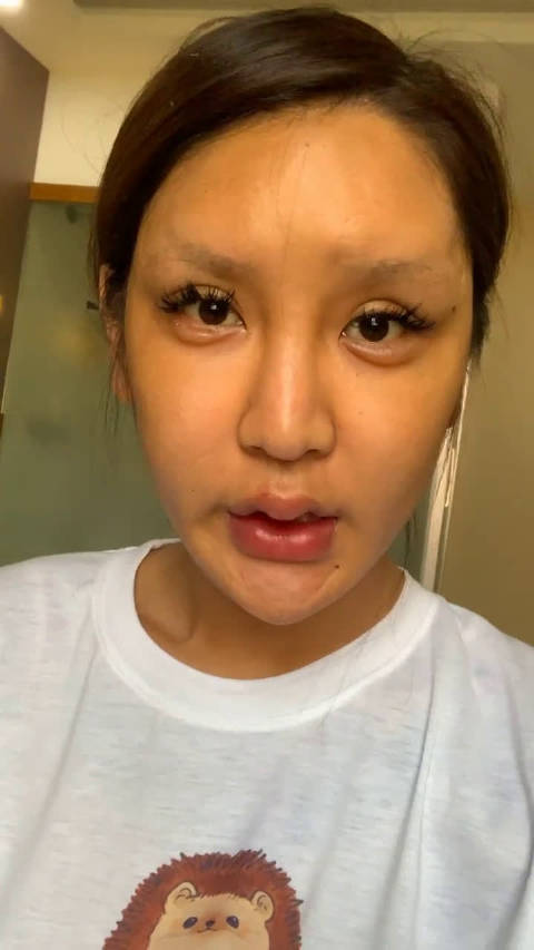 整容后遗症,太可怕了 !