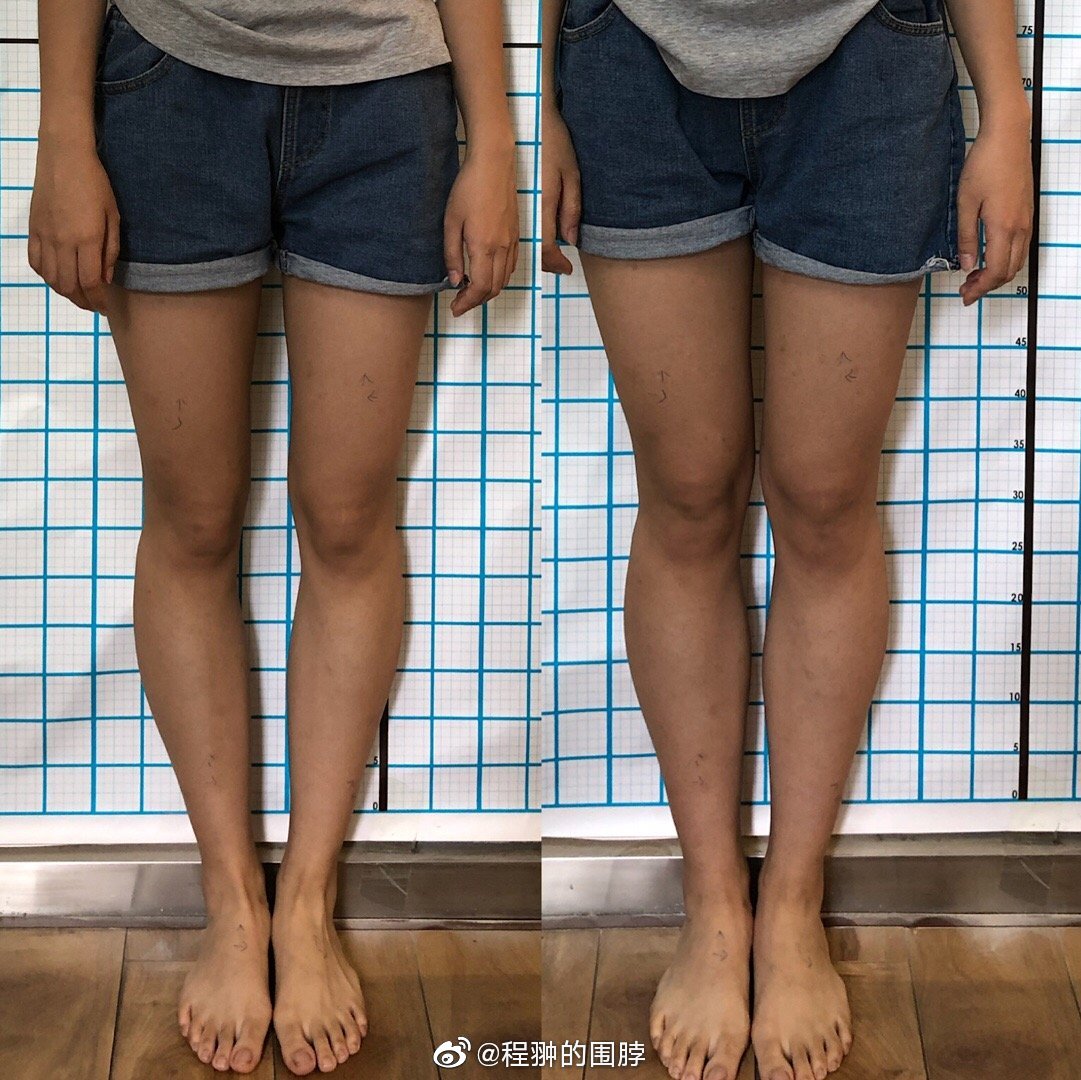 x型腿和o型腿真人图片