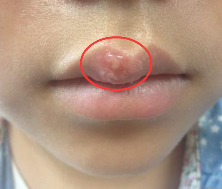 嘴边起水泡是上火的表现,实话告诉你错了,是感染了单纯疱疹病毒,非常