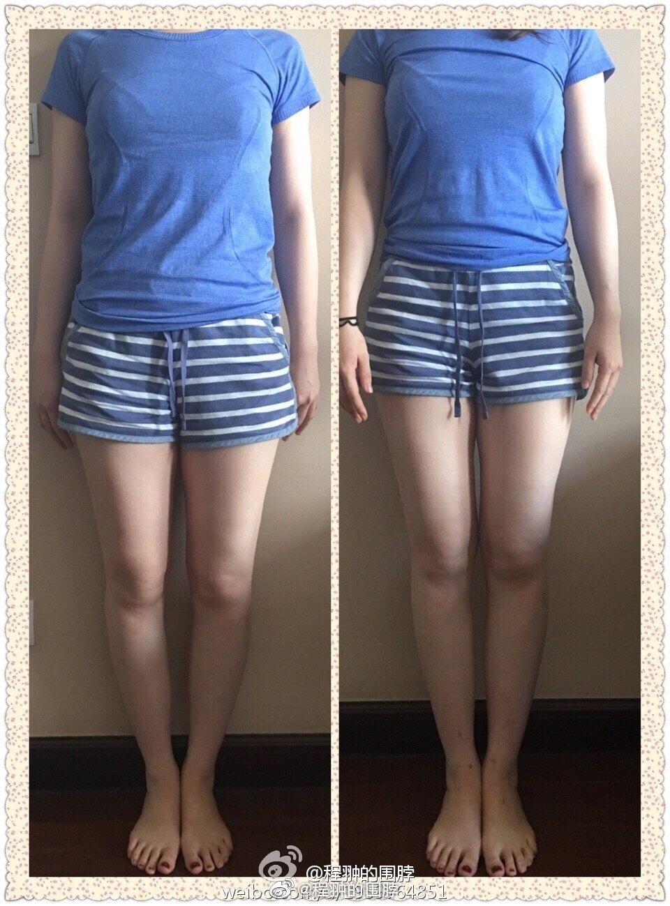 有一种o型腿特别难矫正