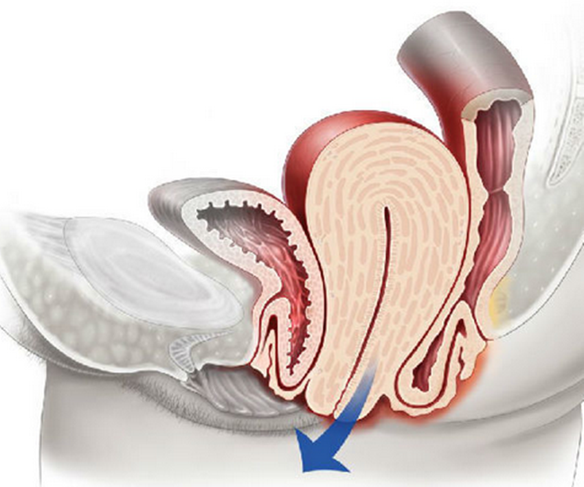 28岁宝妈产后子宫脱垂了解清楚做好产后康复是关键可别大意