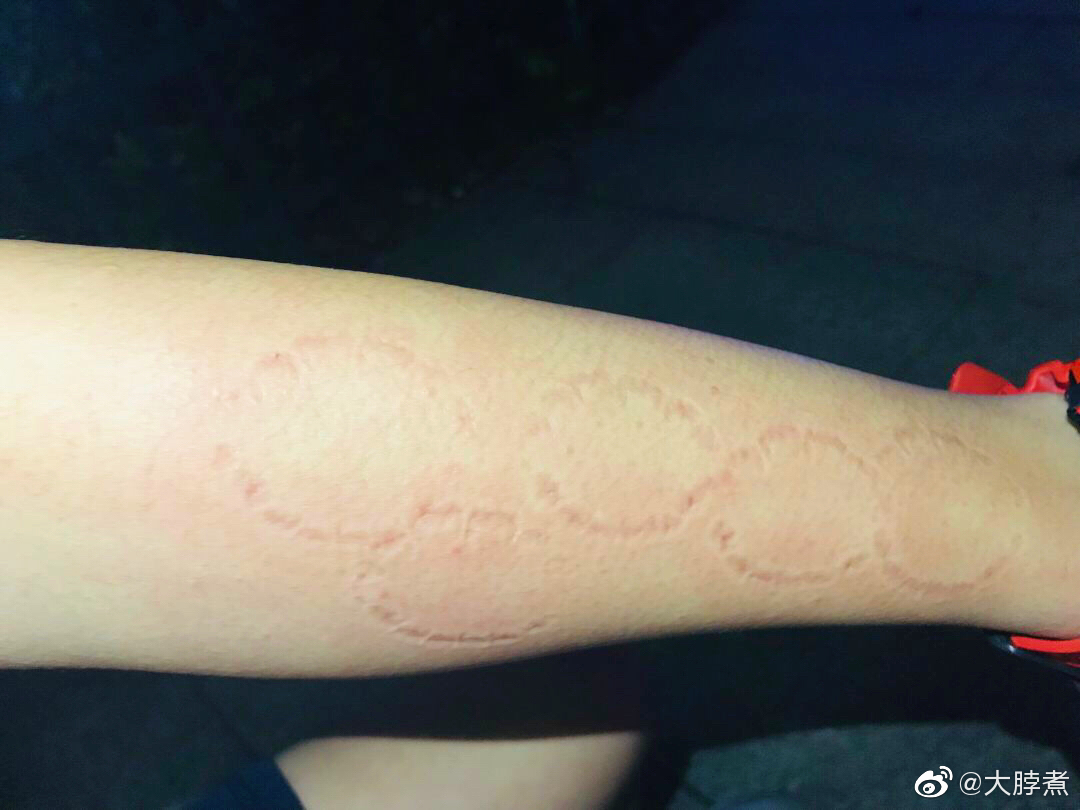 男孩和网恋半年的女友奔现后,自己的胳膊都快被咬成五环了