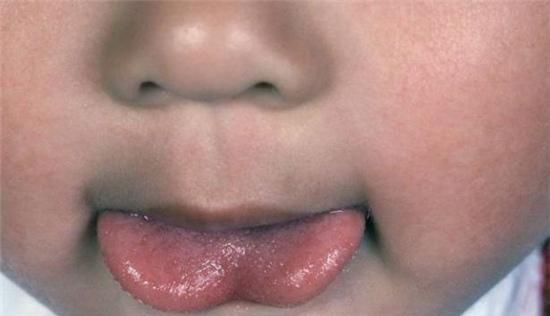 想要宝宝说话早，就得“剪舌根”？看看儿科医生的专业看法|舌系带|舌根|宝宝_新浪新闻