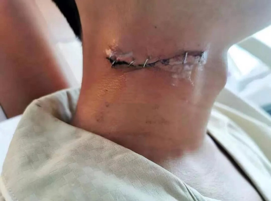 从港警伤口的缝合说起医生的本分是什么