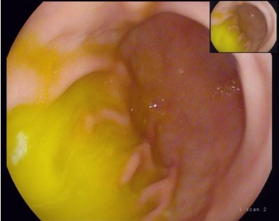 胆囊里的胆汁,怎么会返流到胃里面?胆汁返流性胃炎会癌变吗?