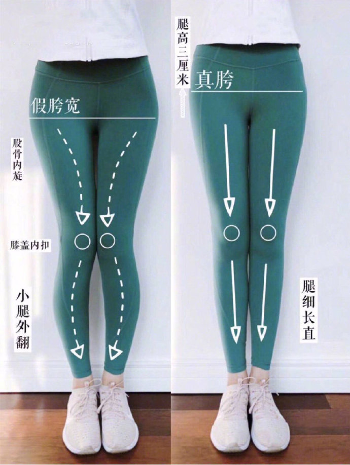 大腿肌肉外翻腿型图片图片