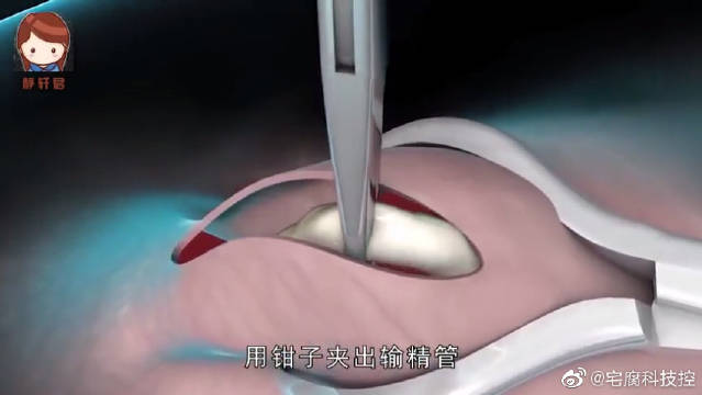 男性结扎手术是怎么做的?别不好意思看，成年人该懂!