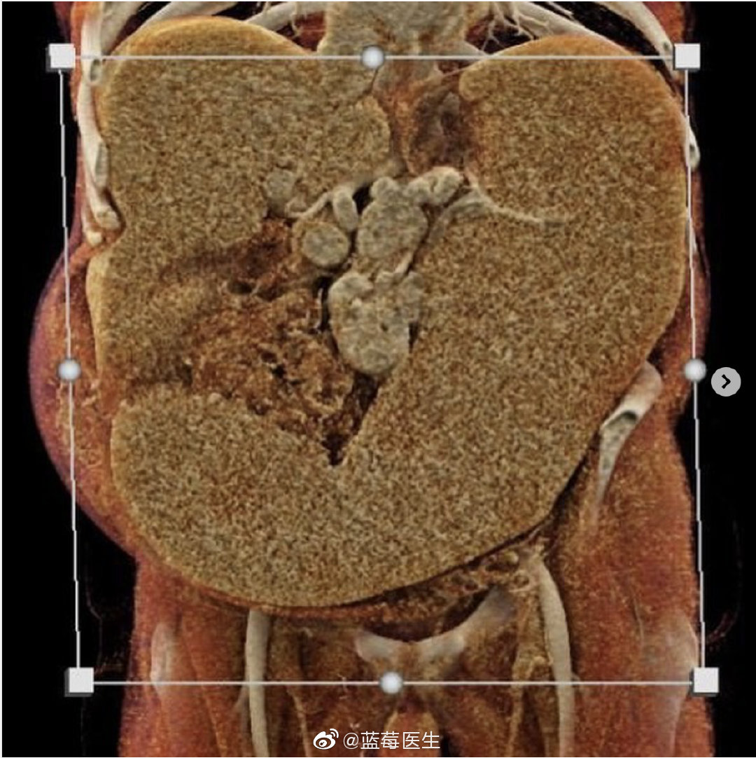 johnshopkinsuniversity放射科的病例红细胞增多症的巨脾