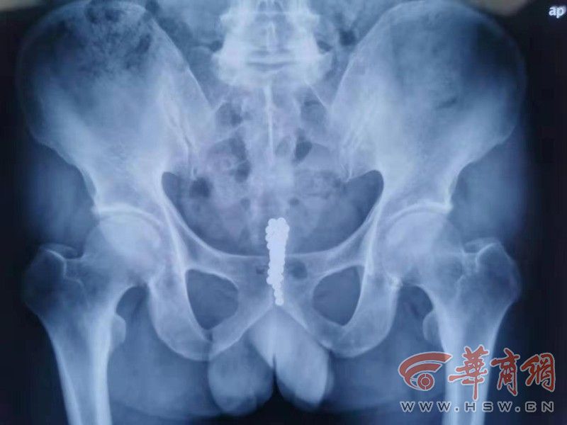 华商报记者 卿荣波10月29日,医生提醒说,从尿道塞异物是非常危险的,"