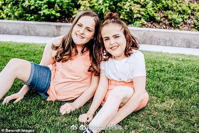 美国犹他州一对连体双胞胎,经历了26个小时的手术之后,被成功分离