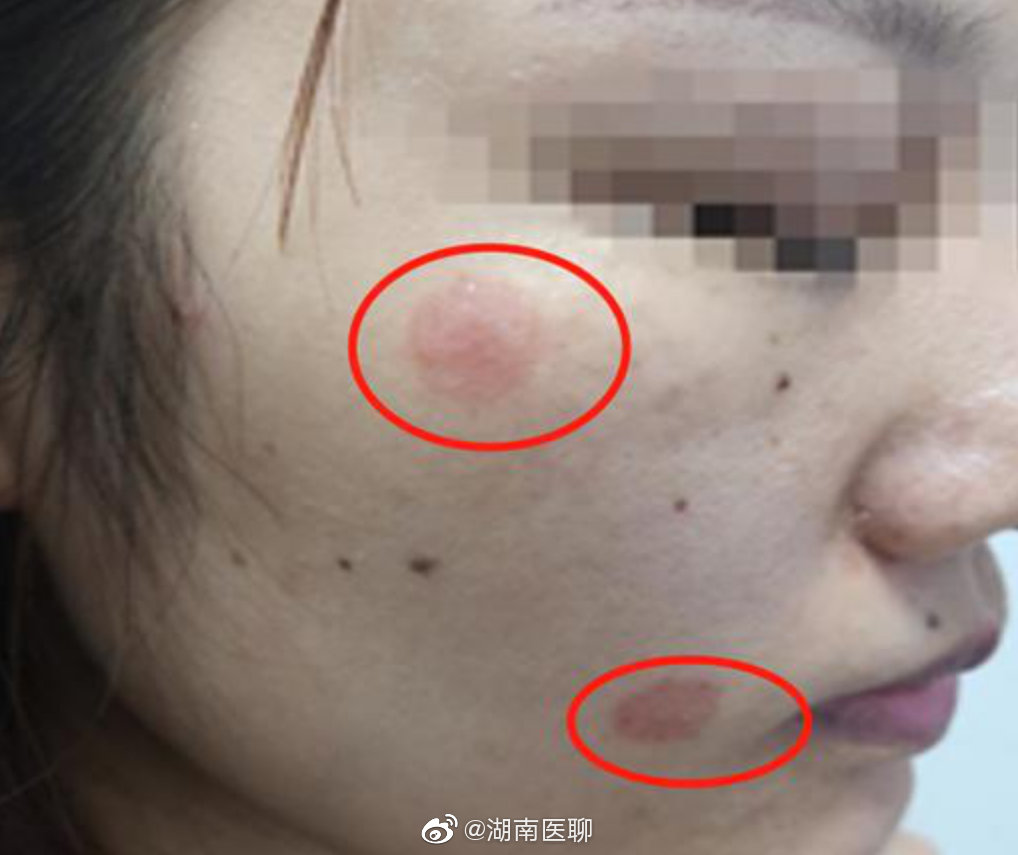 女子爱猫如命经常抱着睡脸上长硬币大红斑