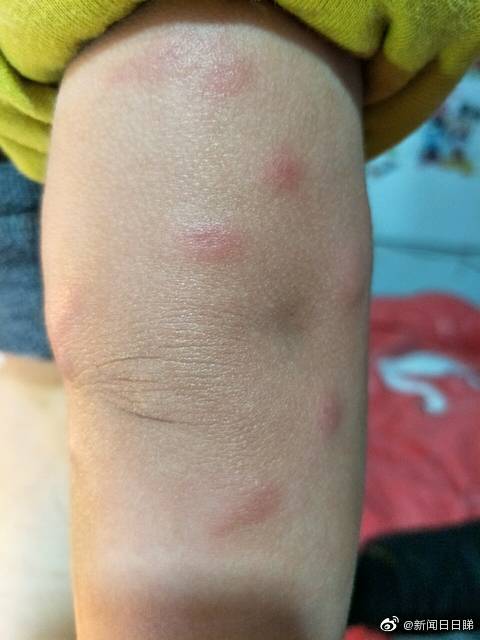 夏日炎炎烤验多警惕儿童皮肤病